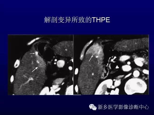 【PPT】螺旋CT动脉期在肝脏异常灌注认识中的价值