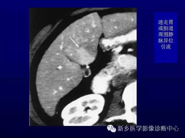 【PPT】螺旋CT动脉期在肝脏异常灌注认识中的价值