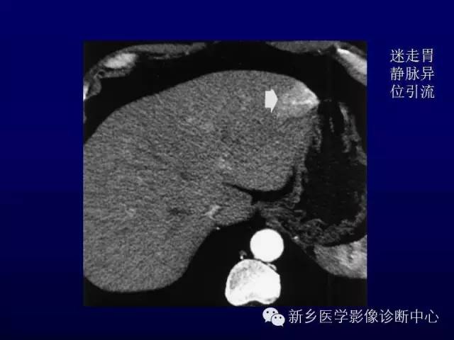 【PPT】螺旋CT动脉期在肝脏异常灌注认识中的价值