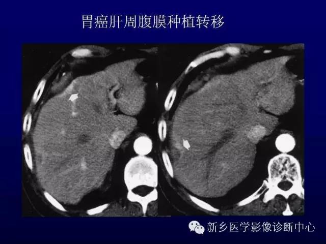 【PPT】螺旋CT动脉期在肝脏异常灌注认识中的价值