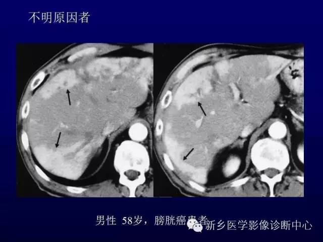 【PPT】螺旋CT动脉期在肝脏异常灌注认识中的价值