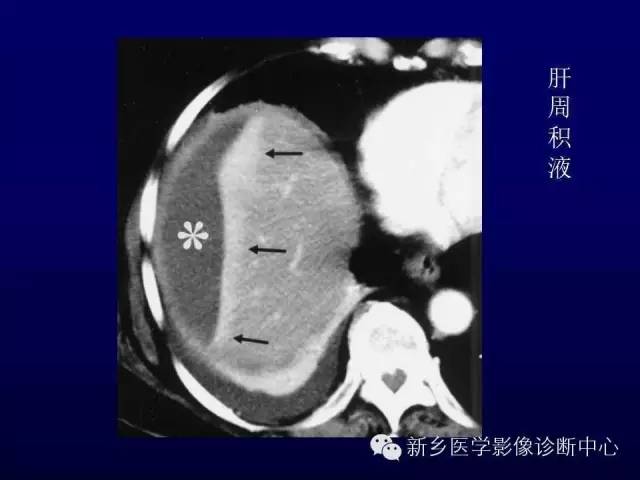 【PPT】螺旋CT动脉期在肝脏异常灌注认识中的价值