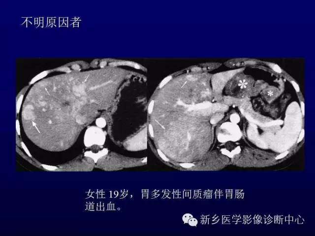 【PPT】螺旋CT动脉期在肝脏异常灌注认识中的价值