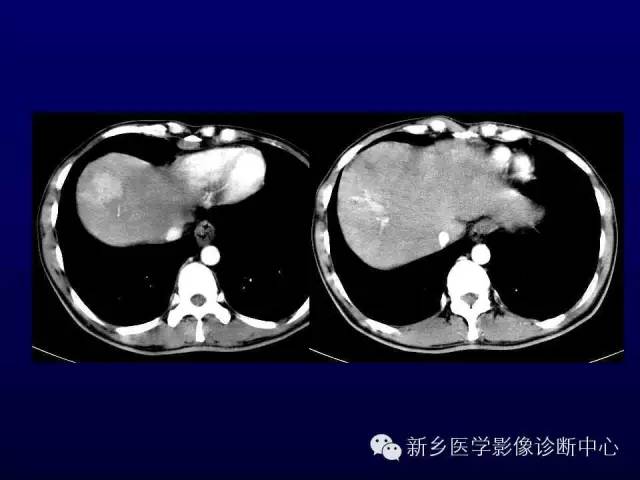 【PPT】螺旋CT动脉期在肝脏异常灌注认识中的价值