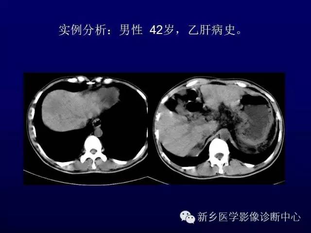 【PPT】螺旋CT动脉期在肝脏异常灌注认识中的价值