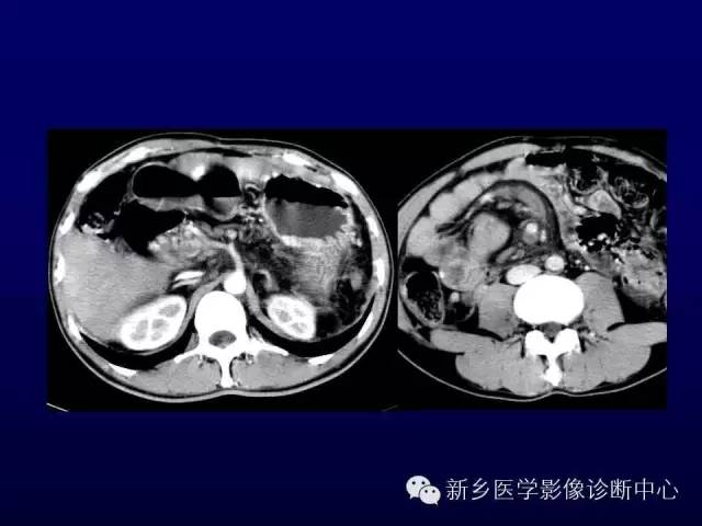 【PPT】螺旋CT动脉期在肝脏异常灌注认识中的价值