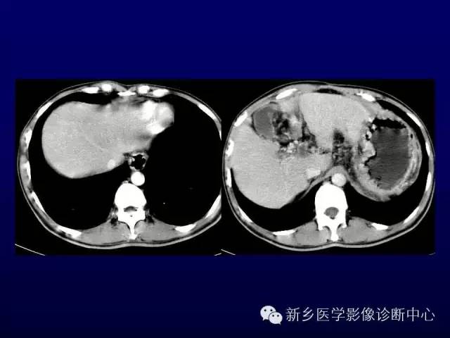 【PPT】螺旋CT动脉期在肝脏异常灌注认识中的价值