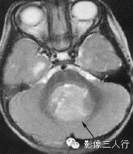 第四脑室区常见肿瘤的鉴别诊断