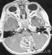 第四脑室区常见肿瘤的鉴别诊断 第四脑室区常见肿瘤的鉴别诊断