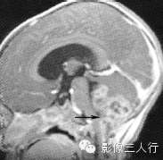 第四脑室区常见肿瘤的鉴别诊断 第四脑室区常见肿瘤的鉴别诊断