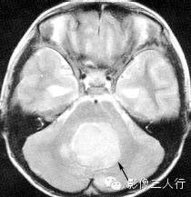 第四脑室区常见肿瘤的鉴别诊断 第四脑室区常见肿瘤的鉴别诊断