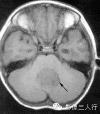 第四脑室区常见肿瘤的鉴别诊断 第四脑室区常见肿瘤的鉴别诊断