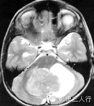 第四脑室区常见肿瘤的鉴别诊断 第四脑室区常见肿瘤的鉴别诊断