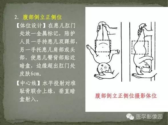 【病例】先天性肛门闭锁1例X线影像表现 【病例】先天性肛门闭锁1例X线影像表现