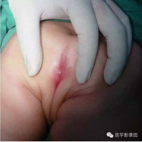【病例】先天性肛门闭锁1例X线影像表现 【病例】先天性肛门闭锁1例X线影像表现