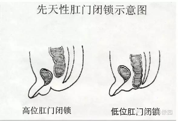 【病例】先天性肛门闭锁1例X线影像表现 【病例】先天性肛门闭锁1例X线影像表现
