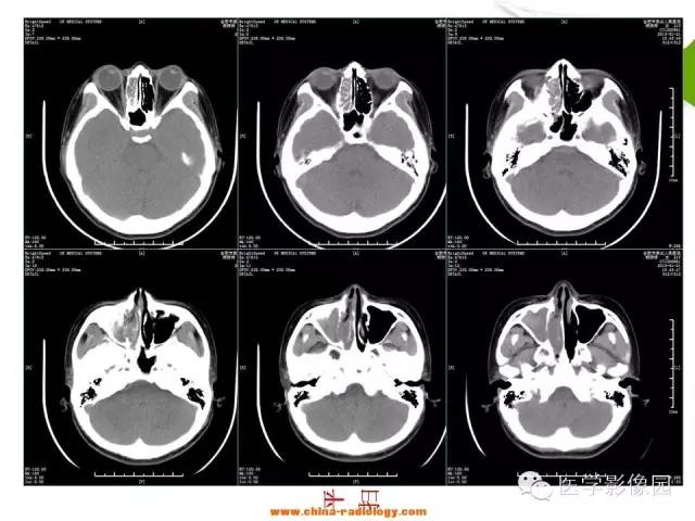 【病例】鼻腔与颈部淋巴结结核1例CT影像表现 【病例】鼻腔与颈部淋巴结结核1例CT影像表现