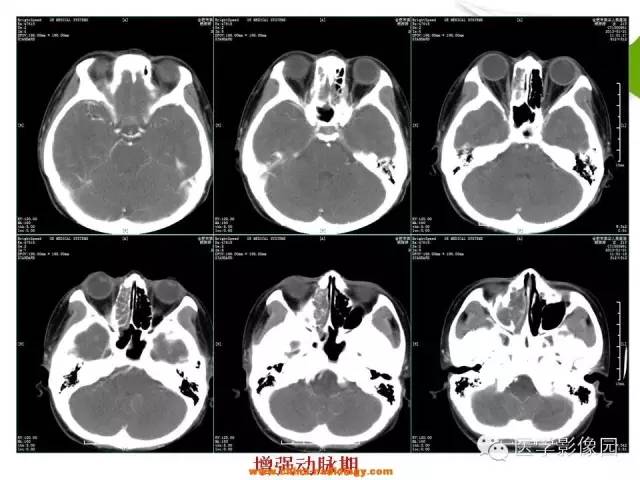 【病例】鼻腔与颈部淋巴结结核1例CT影像表现 【病例】鼻腔与颈部淋巴结结核1例CT影像表现
