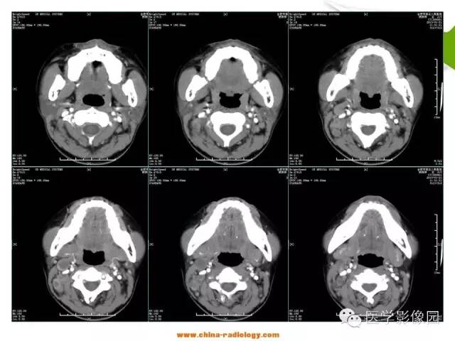 【病例】鼻腔与颈部淋巴结结核1例CT影像表现 【病例】鼻腔与颈部淋巴结结核1例CT影像表现