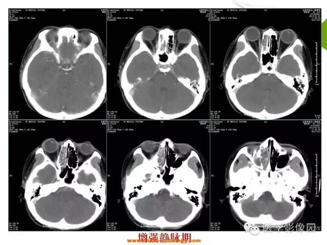 【病例】鼻腔与颈部淋巴结结核1例CT影像表现 【病例】鼻腔与颈部淋巴结结核1例CT影像表现