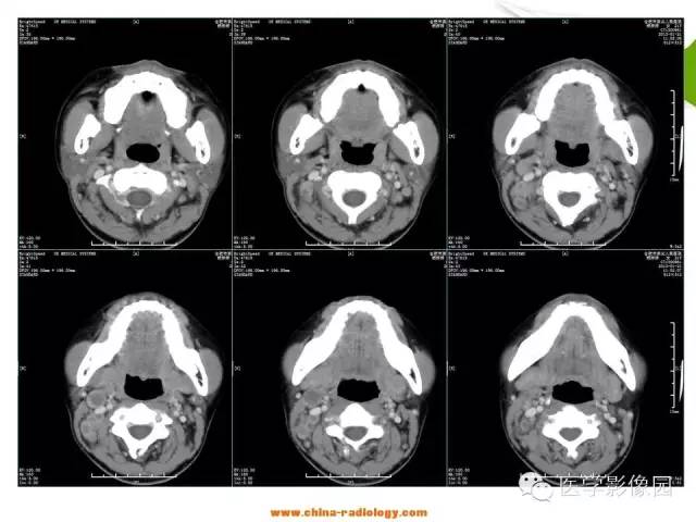 【病例】鼻腔与颈部淋巴结结核1例CT影像表现 【病例】鼻腔与颈部淋巴结结核1例CT影像表现