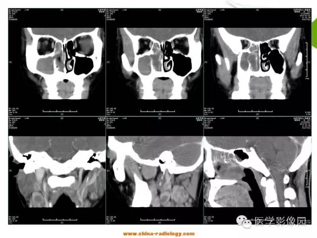 【病例】鼻腔与颈部淋巴结结核1例CT影像表现 【病例】鼻腔与颈部淋巴结结核1例CT影像表现