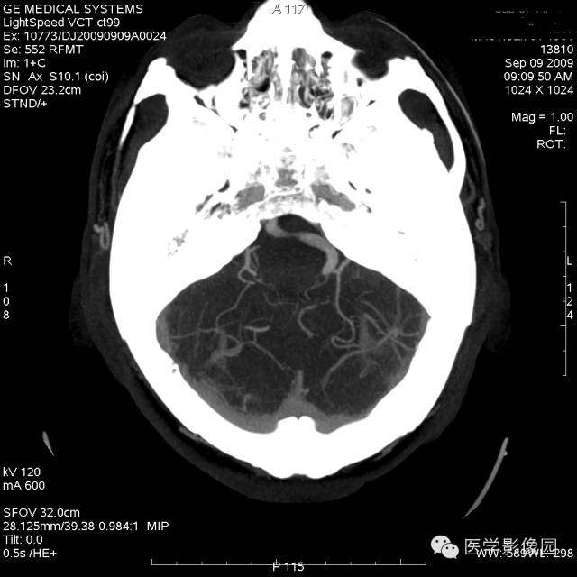 【病例】脑静脉畸形1例CT影像表现 【病例】脑静脉畸形1例CT影像表现