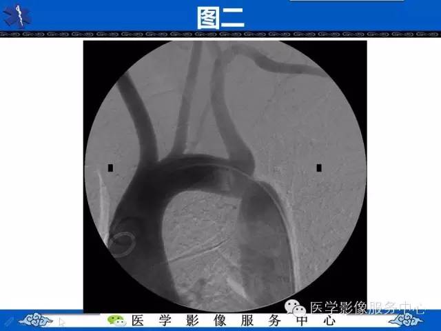 【影像征象】“3”字征——先天性主动脉缩窄