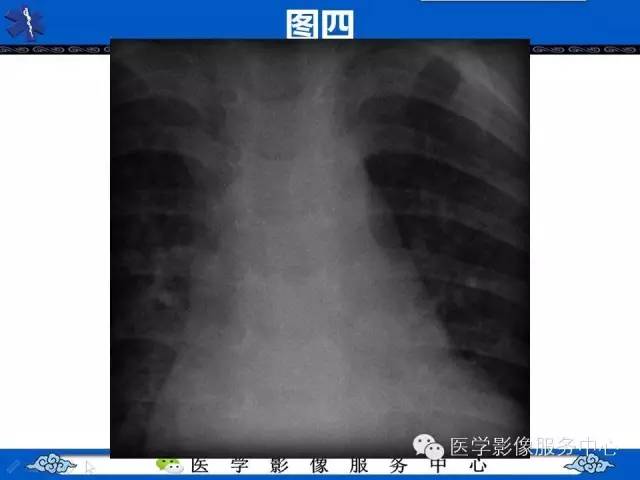 【影像征象】“3”字征——先天性主动脉缩窄