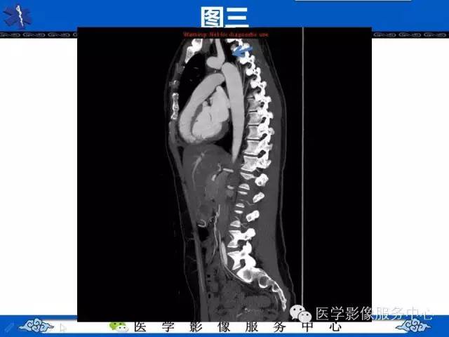 【影像征象】“3”字征——先天性主动脉缩窄