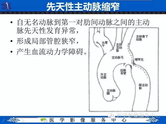 【影像征象】“3”字征——先天性主动脉缩窄