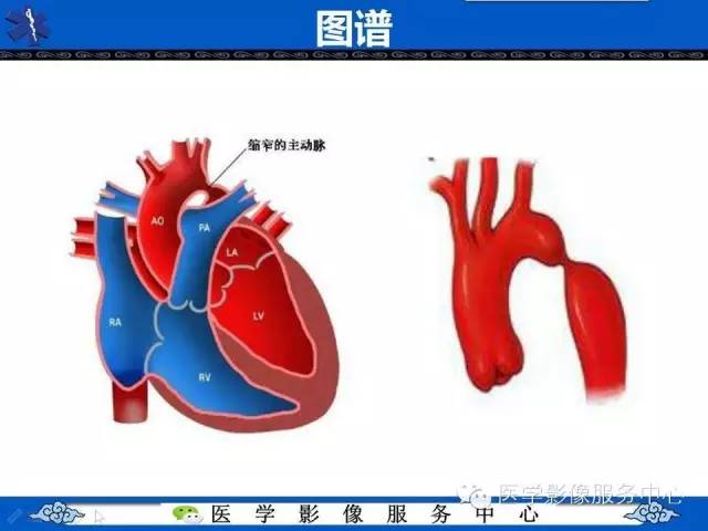 【影像征象】“3”字征——先天性主动脉缩窄