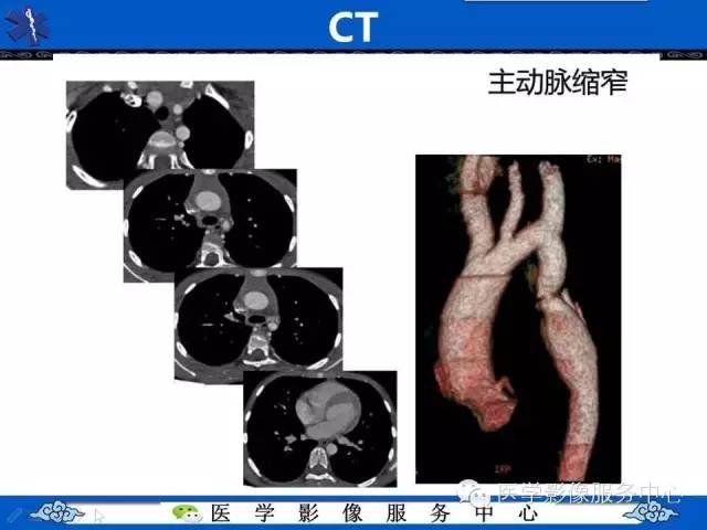 【影像征象】“3”字征——先天性主动脉缩窄