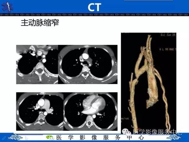 【影像征象】“3”字征——先天性主动脉缩窄