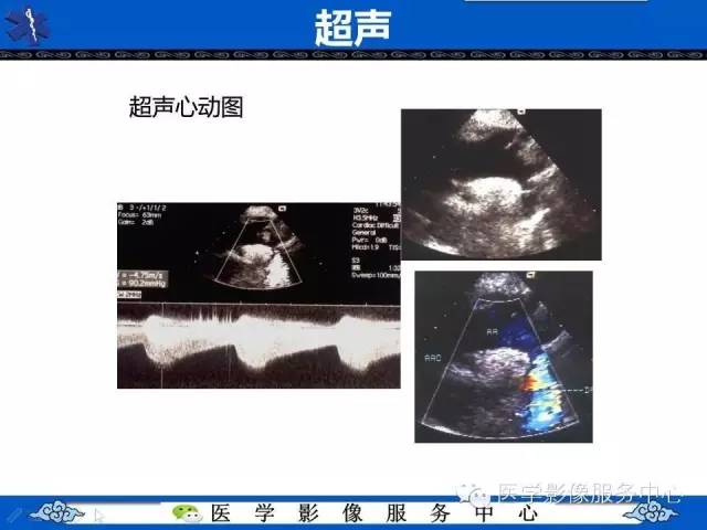 【影像征象】“3”字征——先天性主动脉缩窄
