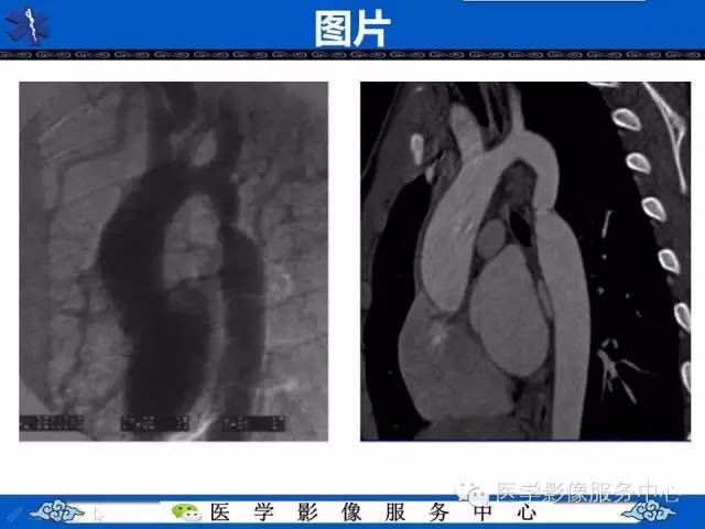 【影像征象】“3”字征——先天性主动脉缩窄