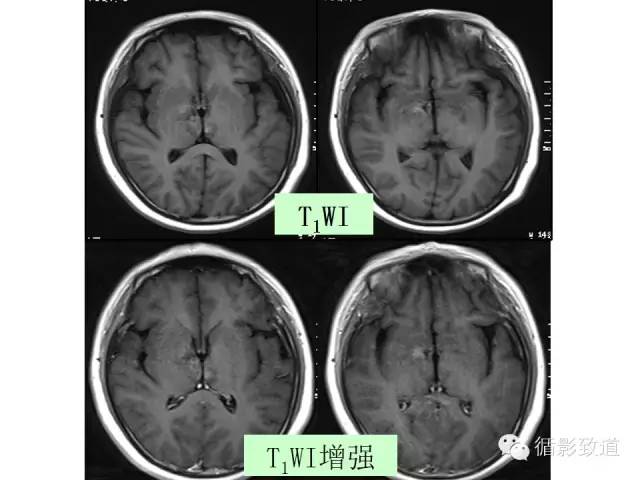 【病例】视神经脊髓炎谱系病1例MR影像表现