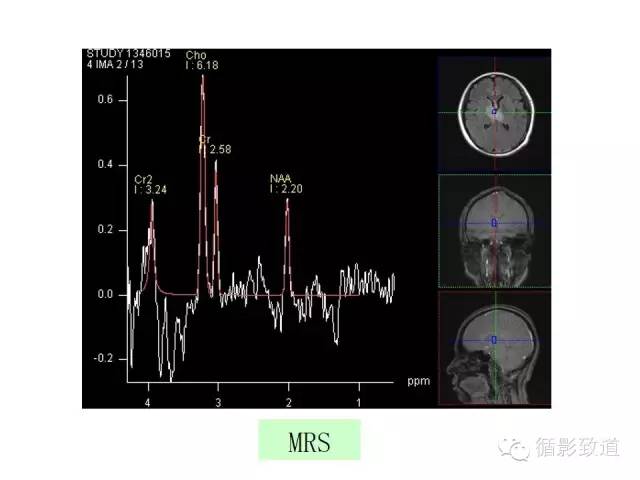 【病例】视神经脊髓炎谱系病1例MR影像表现