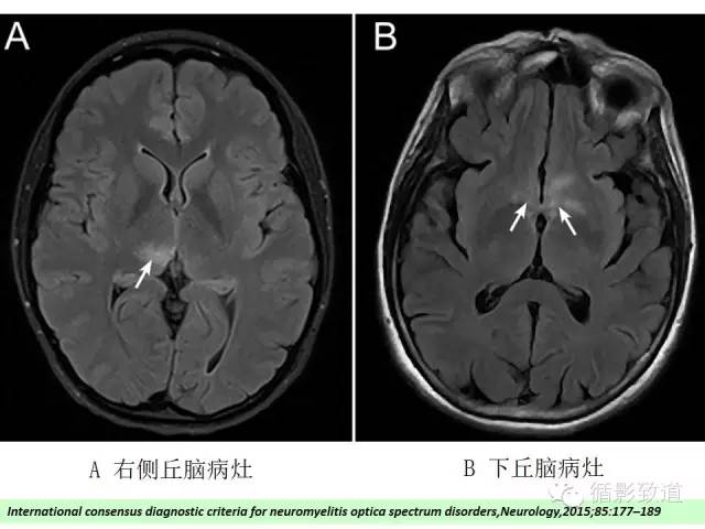 【病例】视神经脊髓炎谱系病1例MR影像表现