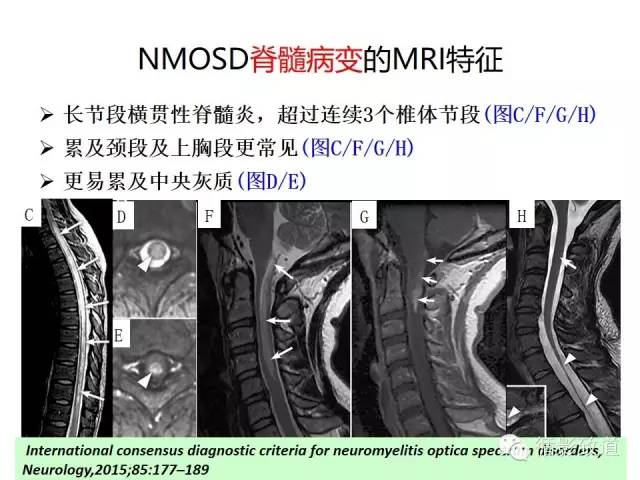 【病例】视神经脊髓炎谱系病1例MR影像表现