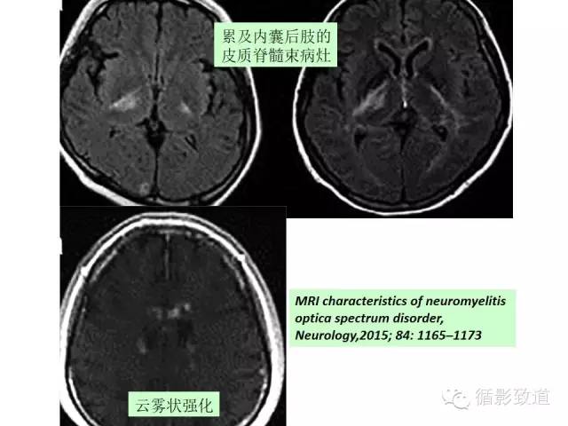 【病例】视神经脊髓炎谱系病1例MR影像表现