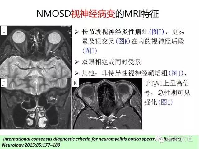 【病例】视神经脊髓炎谱系病1例MR影像表现
