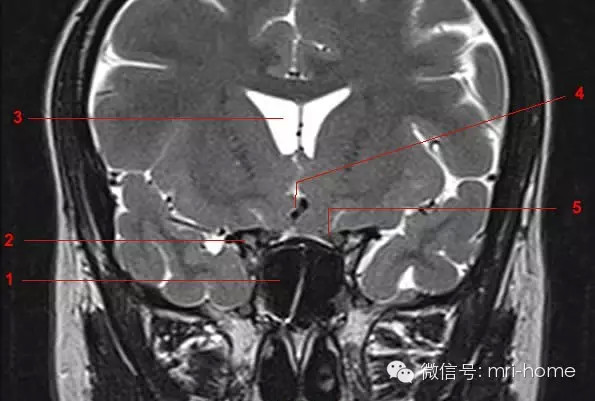 鞍区、垂体磁共振（MRI）解剖——冠状面