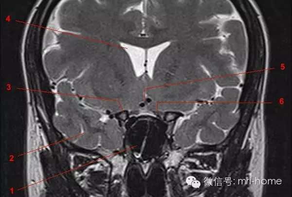 鞍区、垂体磁共振（MRI）解剖——冠状面