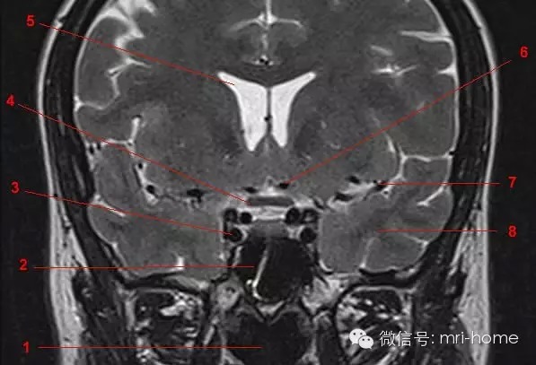 鞍区、垂体磁共振（MRI）解剖——冠状面