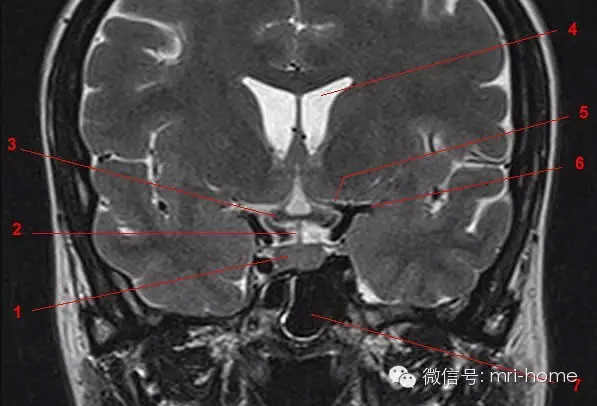 鞍区、垂体磁共振（MRI）解剖——冠状面