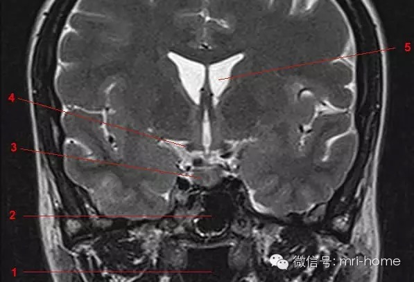 鞍区、垂体磁共振（MRI）解剖——冠状面