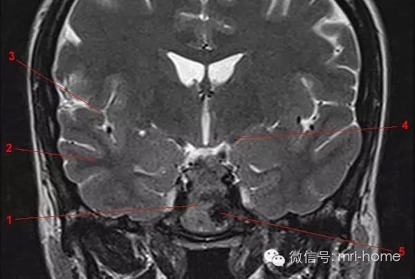 鞍区、垂体磁共振（MRI）解剖——冠状面