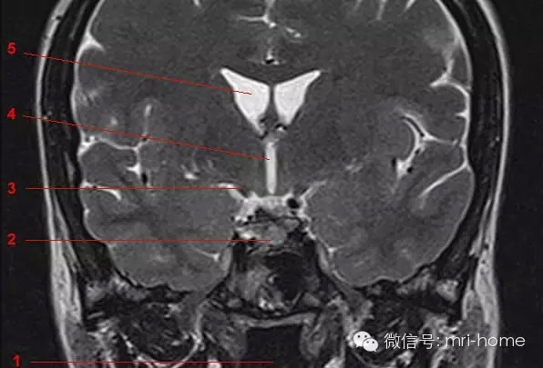 鞍区、垂体磁共振（MRI）解剖——冠状面