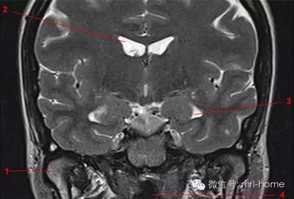 鞍区、垂体磁共振（MRI）解剖——冠状面